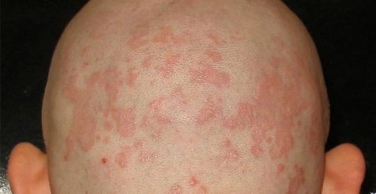 Seborea (seboroická dermatitida) – trpí jí děti i dospělí