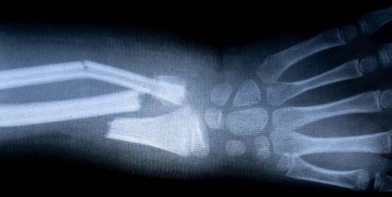 rentgenový film kostra lidské paže. zdravotní lékařská anatomie tělo koncept - zlomenina - stock snímky, obrázky a fotky