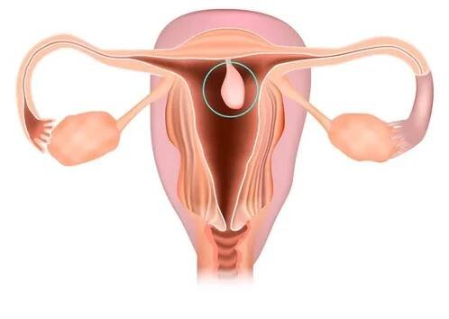 Endometriální polyp nebo děložní polyp. Ilustrace dělohy, onemocnění reprodukčního systému samic — Ilustrace