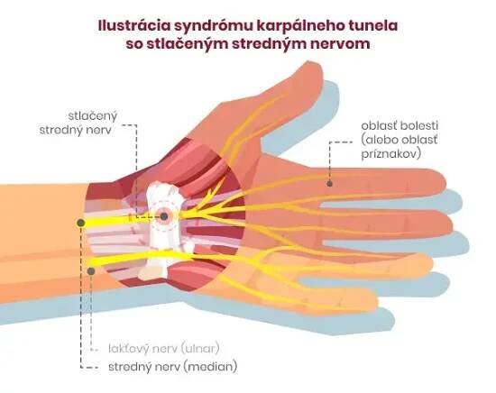 KARPÁLNÍ TUNEL – syndrom karpálního tunelu, příznaky a rychlá pomoc - Pharco