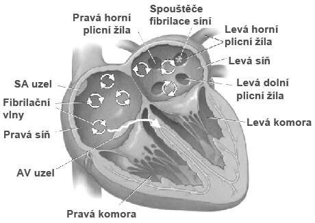 Fibrilace síní - katetrová ablace