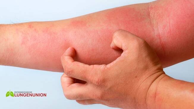 Therapieempfehlungen bei der atopischen Dermatitis - 2024