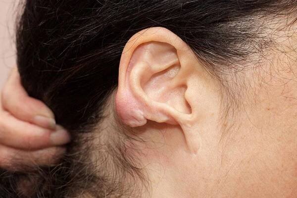 post traumatic ear