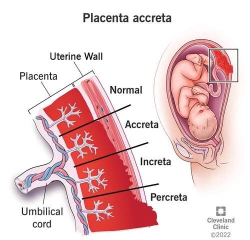 Illustration of a placenta embedding in a uterine wall when a person has placenta accreta, increta or percreta.