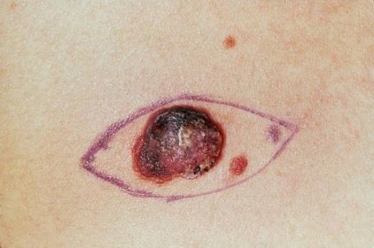 Rakoviny kůže drasticky přibývá. Můžou za to levné letenky, říkají lékaři