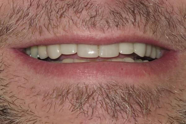 Full Mouth Rehabilitation Smile Gallery - Raber Dental, Kidron Dentist