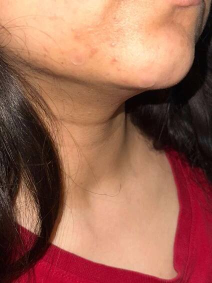 wearing nua pimple patch
