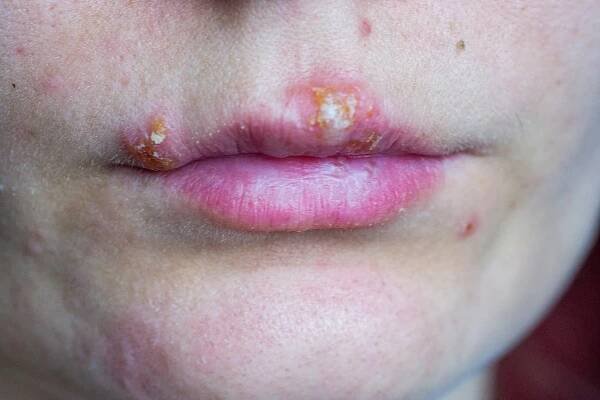 Herpes: Príčiny a spôsoby ako sa ho zbaviť