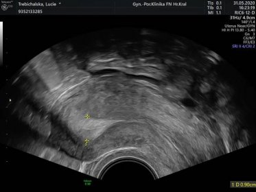 obr. 2a 2D ultrazvuk dělohy, měření výšky děložní sliznice 