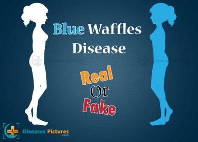 What Is A Blue Waffle Disease – Real Or Fake? Is Blue Waffles Disease A STD? | #site_title