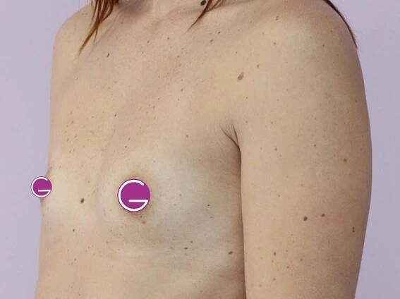 Zvětšení prsou - augmentace - GIA Clinic