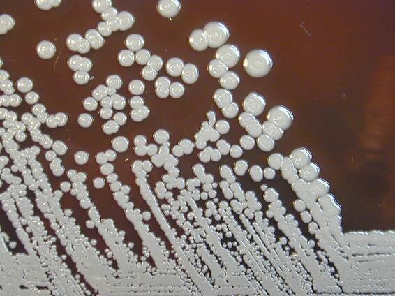Melioidosis is an infectious disease caused by the bacteria Burkholderia pseudomallei