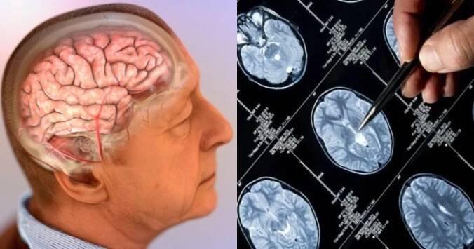 Příznaky Alzheimerovy choroby se vyvíjí spolu se závažností. Kritické stádium lze předpovědět a VYVAROVAT se mu už 20 LET předem