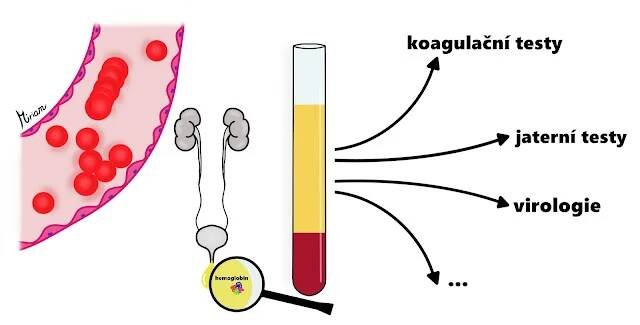 Autoimunitní hemolytická anemie (AIHA) - Axon