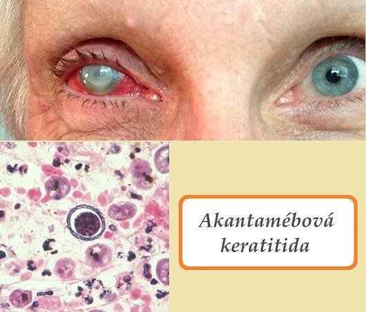 akantamebova keratitida priznaky projevy symptomy