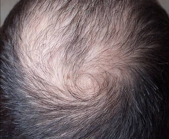Dallas Hair Replacement Styles - Dallas Hair Replacement Styles
