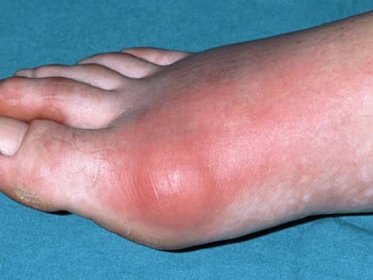 DNA na nohou zdroj www.physio pedia.com Co je nemoc dna? A jak se pozná nemoc dna?