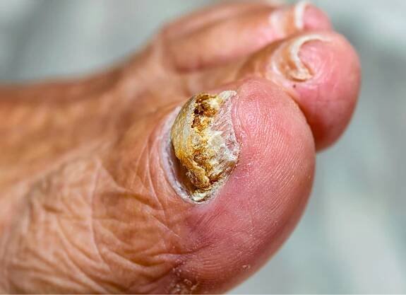 Fungal Skin Infections | ProDerm UK