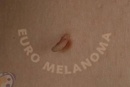 Kožní fibromy - Euromelanoma 