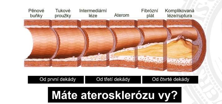 Každá pátá osoba, která prodělala infarkt, ho dostane do pěti let znovu. Jak mu předcházet a léčit se?