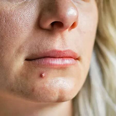 Pimple vs. Cold Sore: Differences and Similarities