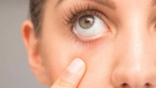 Herpes v oku sa prejavuje najmä na viečku pri mihalniciach, v podobe malých pľuzgierov.