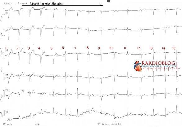 (EKG Kazuistika) Frekvenčně závislá blokáda levého raménka Tawarova - Kardioblog