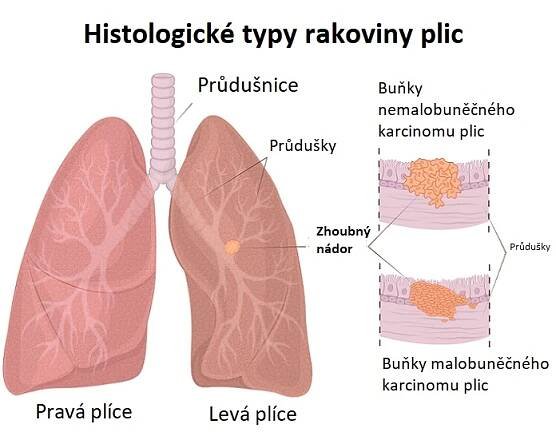Histologické typy rakoviny plic - ilustrace