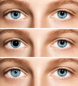 Have One Pupil Bigger Than the Other? - Anisocoria
