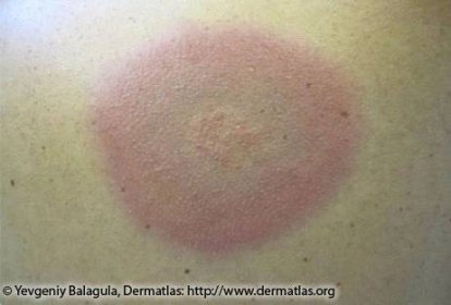Bluish rash, no central clearing