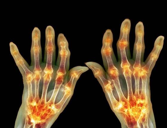Pacienti s revmatoidní artritidou mají vyšší riziko Sjögrenova syndromu