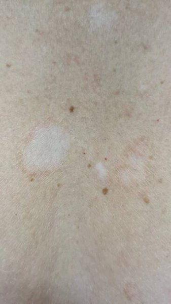 Pityriasis versicolor – Dr Konrad Pharma