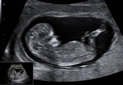 těhotenství - ultrazvuk