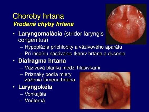 PPT - Choroby hrtana, priedušnice a krku PowerPoint Presentation, free download - ID:457256