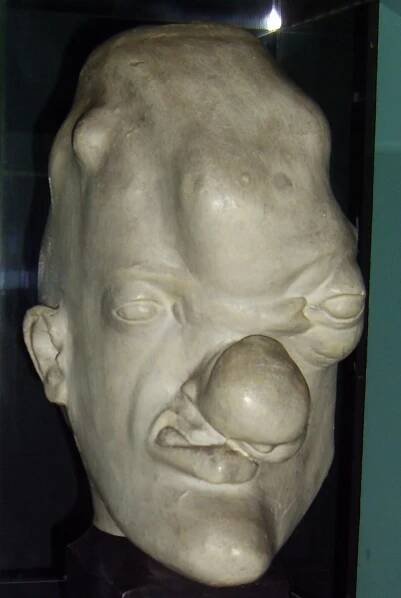 Soubor:Tertiary syphilis head.JPG – Wikipedie