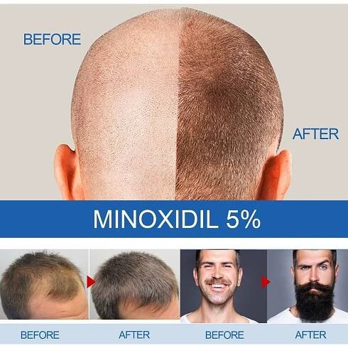 PDTO Minoxidil 5% Extra Strength for Men Tekutá kúra pro obnovu růstu vlasů