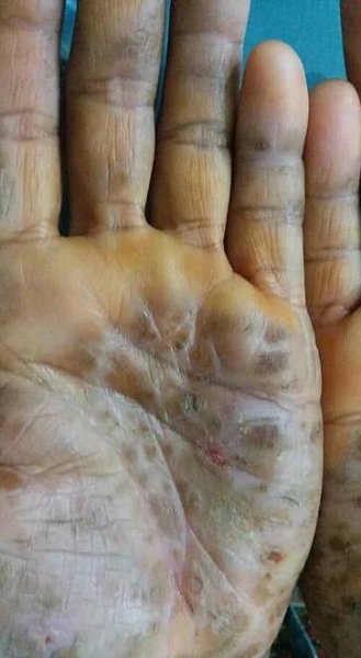 Palmoplantar keratoderma - Wikipedia