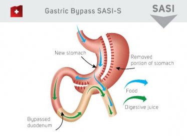Gastric Bypass SASI-S