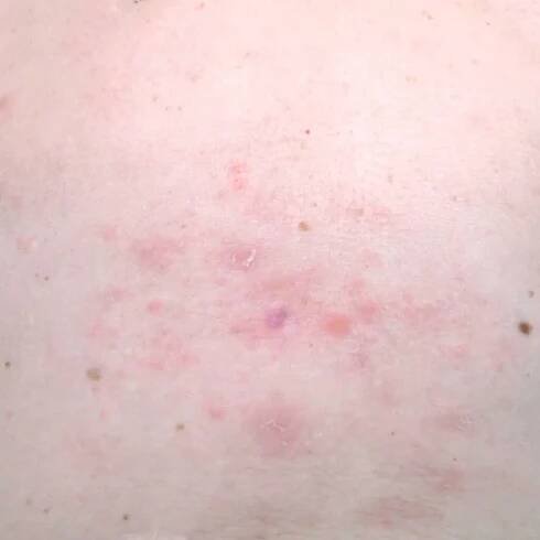 Kožní vyrážka léčba na těle ženy. pásový opar, choroba, herpes zoster, virus varicella-zoster. kožní vyrážka a puchýře na těle. Pozadí — Stock obrázek