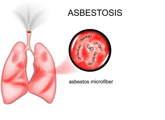 asbestosis