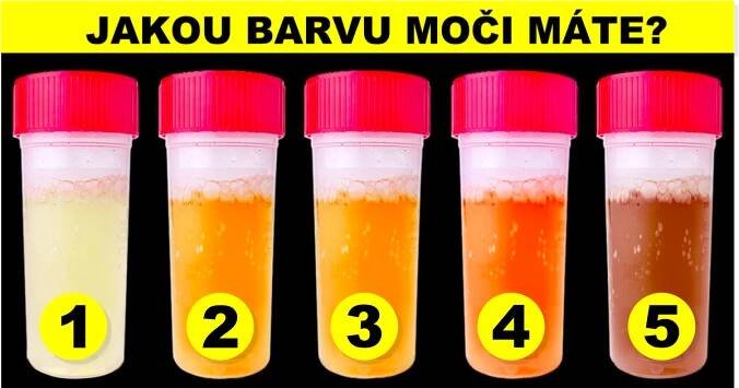 Každá barva moči může značit jiný zdravotní problém. Jedna dokonce varuje před rakovinou a mozkovým onemocněním