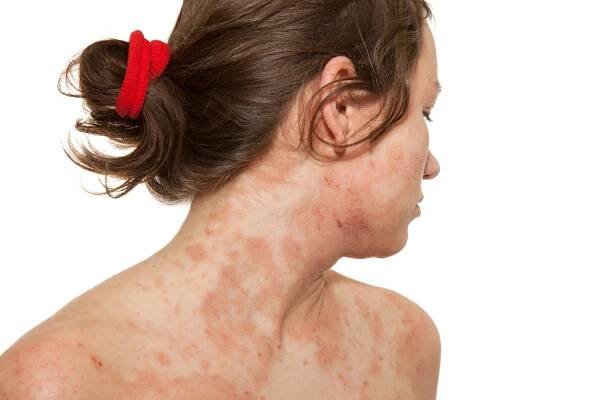 žena s kožní poruchou atopické dermatitidy - vyrážka kožní onemocnění - stock snímky, obrázky a fotky