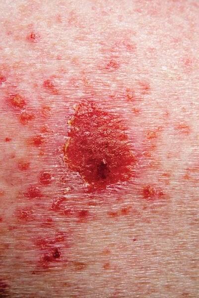 Carcinoma