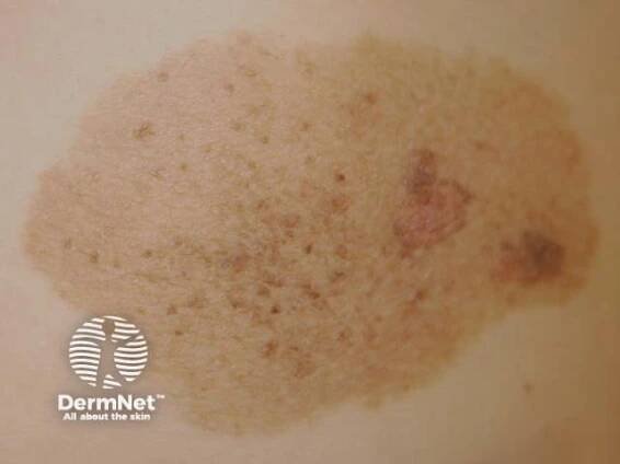 Moles (melanocytic naevi, pigmented nevi)
