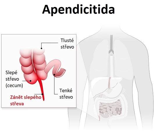 Apendicitida (zánět slepého střeva)