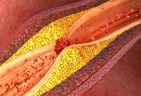 Coronary Heart Disease (CHD)
