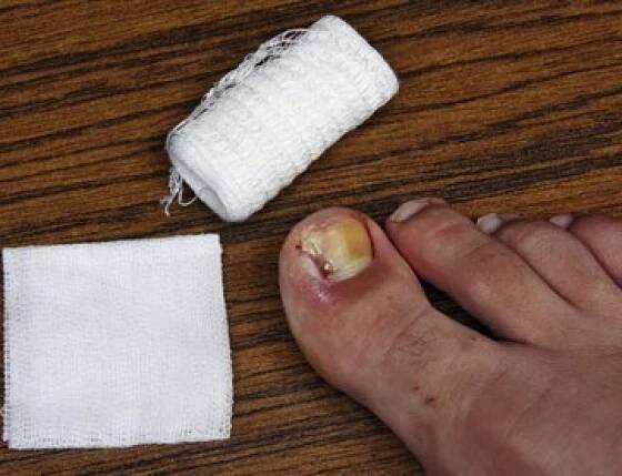 OUCH! Painful Ingrown Toenail Alert