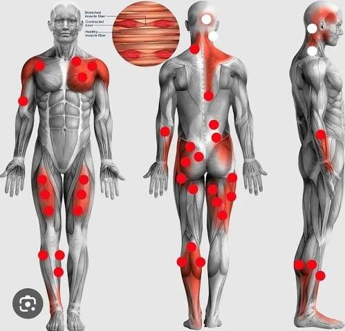What is a Muscle Knot and How we can treat it? - anrc-uk.com