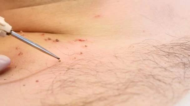 Pojem chirurgie. Papilomy odstranění. Zblízka. Lékař odstraní Krtek v chirurgickém zákroku spálením lékařských nástrojů a zařízení na mužské tělo — Stock záběr