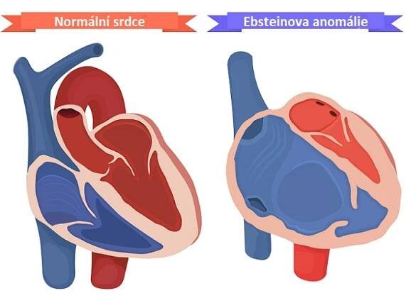 Ebsteinova anomálie - ilustrace